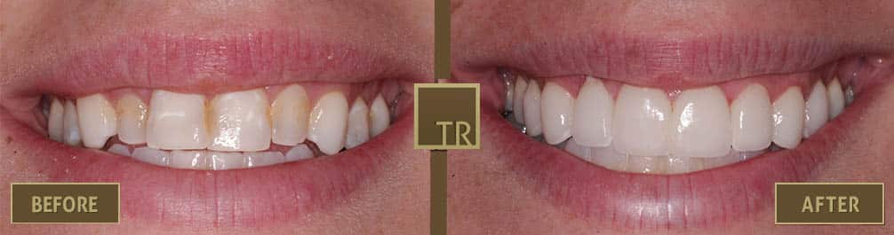 8 Porcelain Veneers Decorative Image
